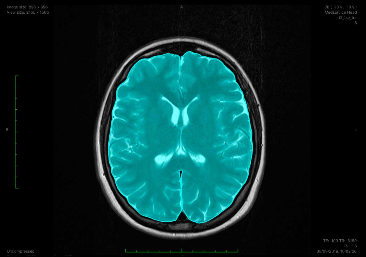 How Medical Annotation is Helping Diagnose Brain Tumours